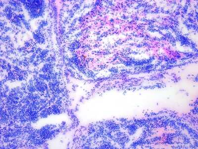 Hematoxylin & Eosin Stain: Parotid Tissue Slides (Tumor)- Frozen [NBP2-77643]