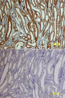 beta -Catenin antibody in Human Kidney Cancer Tissue by Immunohistochemistry (IHC-P).