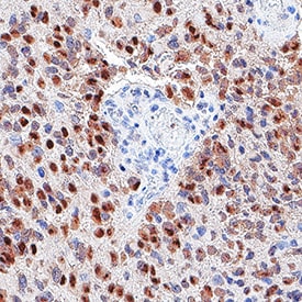 Detection of SOX2 in glioblastoma.