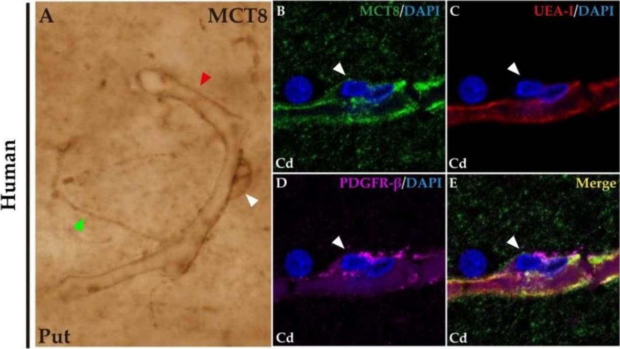 Detection of Human PDGF R beta by Immunohistochemistry