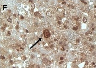 Detection of Human Survivin by Immunohistochemistry