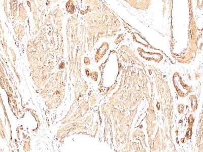 Immunohistological Detection of alpha-Smooth Muscle Actin in Paraffin Embedded Human Leiomyosarcoma