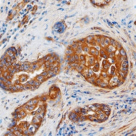 ST8 a-2,8-Sialyltransferase 8A/ST8SIA1 antibody in Human Breast Cancer Tissue by Immunohistochemistry (IHC-P).