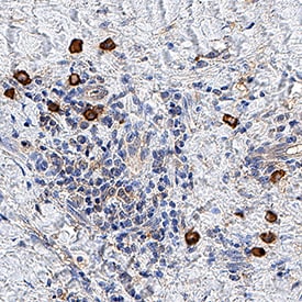 20S Immunoproteasome antibody in Human Lung Cancer Tissue by Immunohistochemistry (IHC-P).