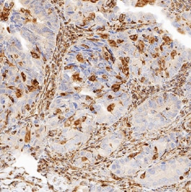 20S Proteasome antibody in Human Lung Cancer Tissue by Immunohistochemistry (IHC-P).