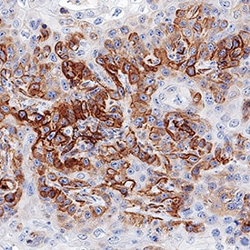 5'-Nucleotidase/CD73 antibody in Human Cervical Cancer Tissue by Immunohistochemistry (IHC-P).