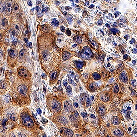 5'-Nucleotidase/CD73 antibody in Human Cervical Cancer Tissue by Immunohistochemistry (IHC-P).
