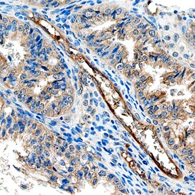 ACP6 antibody in Human Ovarian Cancer Tissue by Immunohistochemistry (IHC-P).