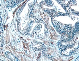 ADAM10 antibody in Human Prostate Cancer Tissue by Immunohistochemistry (IHC-P).