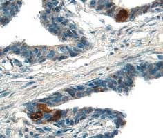 ADAM15 antibody in Human Prostate Cancer Tissue by Immunohistochemistry (IHC-P).