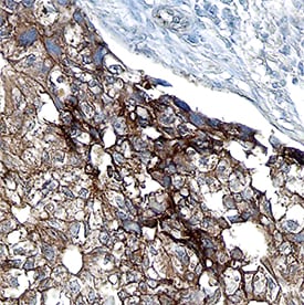 ALK-7 antibody in Human Breast Cancer Tissue by Immunohistochemistry (IHC-P).