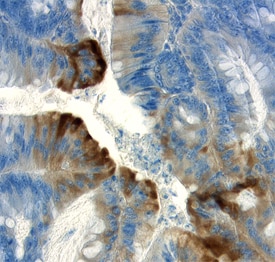 APC antibody in Human Colon Cancer Tissue by Immunohistochemistry (IHC-P).