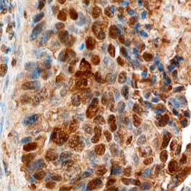 ATM antibody in Human Breast by Immunohistochemistry (IHC-P).