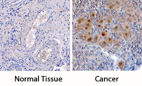 ATR antibody in Human Ovarian Cancer Tissue by Immunohistochemistry (IHC-P).