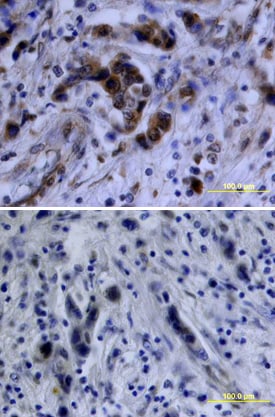 Akt antibody in Human Breast Cancer Tissue by Immunohistochemistry (IHC-P).