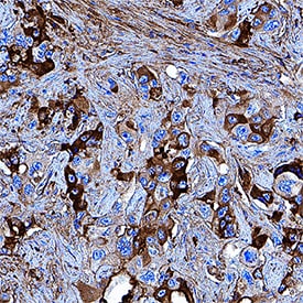 Apolipoprotein A-I/ApoA1 antibody in Human Liver Cancer Tissue by Immunohistochemistry (IHC-P).