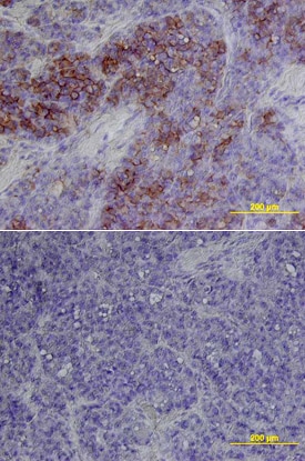 B7-H3 antibody in Human Melanoma by Immunohistochemistry (IHC-P).