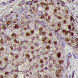 BMI‑1 antibody in Human Breast Cancer Tissue by Immunohistochemistry (IHC-P).