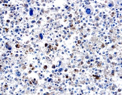 BMP-8 antibody in Human Osteo-sarcoma by Immunohistochemistry (IHC-P).