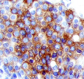 BRCA1 antibody in Human Breast Cancer Tissue by Immunohistochemistry (IHC-P).