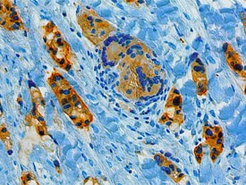 BRCA1 antibody in Human Breast Cancer Tissue by Immunohistochemistry (IHC-P).