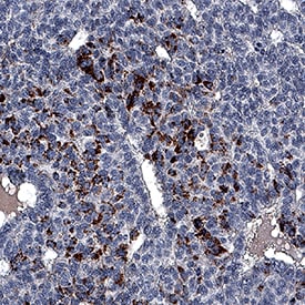 Bradykinin RB2/BDKRB2 antibody in Human Liver Cancer Tissue by Immunohistochemistry (IHC-P).