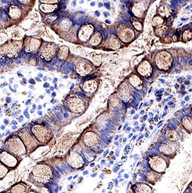 CCL2/JE/MCP-1 antibody in Human Crohn's Disease Intestine by Immunohistochemistry (IHC-P).