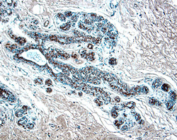 CCL2/JE/MCP-1 antibody in Human Breast Cancer Tissue by Immunohistochemistry (IHC-P).