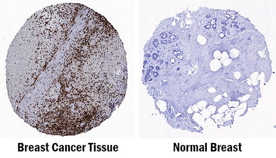 CD15/Lewis X antibody in Human Breast Cancer Tissue by Immunohistochemistry (IHC-P).
