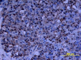 CD24 antibody in Human Ovarian Cancer Tissue by Immunohistochemistry (IHC-P).