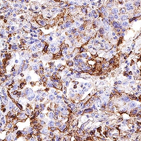 CD63 antibody in Human Lung Cancer Tissue by Immunohistochemistry (IHC-P).
