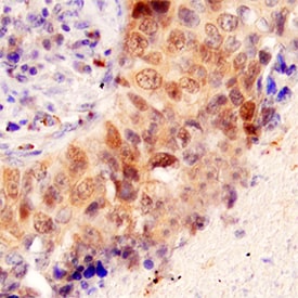 CDK2 antibody in Human Lung Cancer Tissue by Immunohistochemistry (IHC-P).