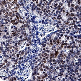 CDX2 antibody in Human Colon Cancer Tissue by Immunohistochemistry (IHC-P).