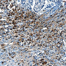 CIB1 antibody in Human Breast Cancer Tissue by Immunohistochemistry (IHC-P).