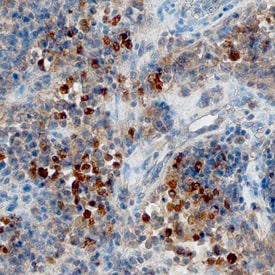 CXCL13/BLC/BCA-1 antibody in Human Lymphoma by Immunohistochemistry (IHC-P).