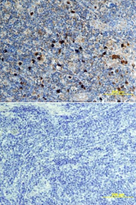 CXCL16 antibody in Human Lymphoma by Immunohistochemistry (IHC-P).