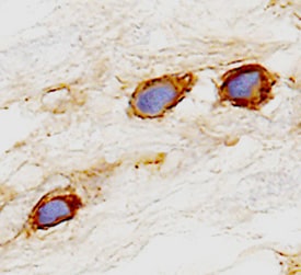 Cadherin‑6/KCAD antibody in Human Kidney Cancer Tissue by Immunohistochemistry (IHC-P).