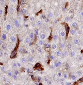 Cadherin‑6/KCAD antibody in Human Liver Cancer Tissue by Immunohistochemistry (IHC-P).