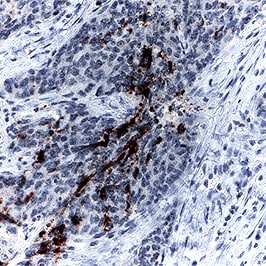 Caspase-3 antibody in Human Colon Cancer Tissue by Immunohistochemistry (IHC-P).