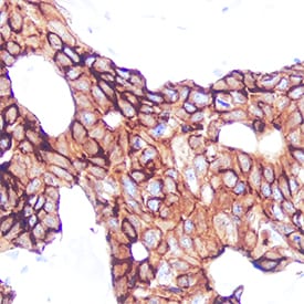 Cytokeratin 19 antibody in Human Breast Cancer Tissue by Immunohistochemistry (IHC-P).