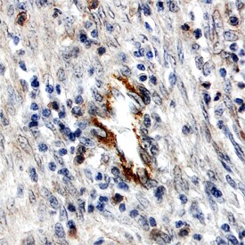 DDR1 antibody in Human Breast Cancer Tissue by Immunohistochemistry (IHC-P).