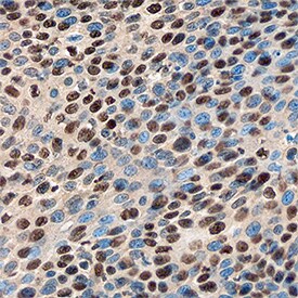 DEK antibody in Human Cervical Cancer Tissue by Immunohistochemistry (IHC-P).