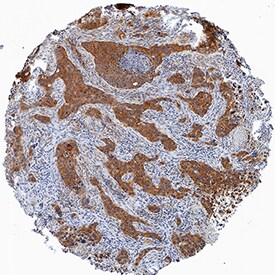 DPP3 antibody in Human Squamous Cell Carcinoma by Immunohistochemistry (IHC-P).