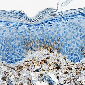 DPPIV/CD26 antibody in Human Psoriatic Skin by Immunohistochemistry (IHC-P).