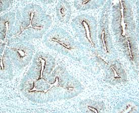 DcR3/TNFRSF6B antibody in Human Stomach Cancer Tissue by Immunohistochemistry (IHC-P).