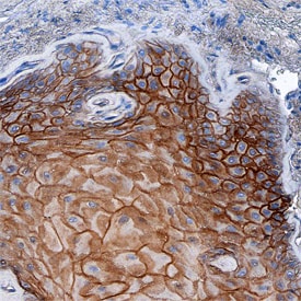 Desmoglein-3 antibody in Human Squamous Cell Carcinoma by Immunohistochemistry (IHC-P).
