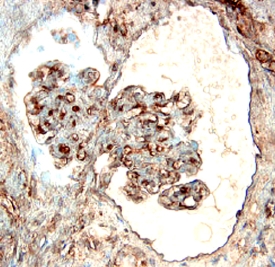 E‑Selectin/CD62E antibody in Human Kidney Cancer Tissue by Immunohistochemistry (IHC-P).