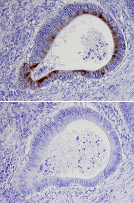ECM‑1 antibody in Human Colon Cancer Tissue by Immunohistochemistry (IHC-P).
