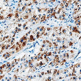 EGF antibody in Human Lung Cancer Tissue by Immunohistochemistry (IHC-P).