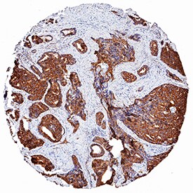 EMAP-II antibody in Human Prostate Cancer Tissue by Immunohistochemistry (IHC-P).